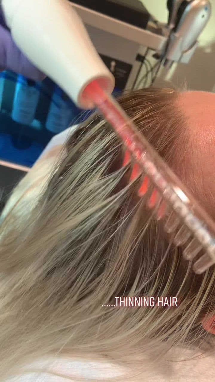 High frequency combo ⚡️ #thespaataltmanaeathetics #hairrejuvenation #highfrequency #facials #medspa #injectables #englewoodcliffsnj